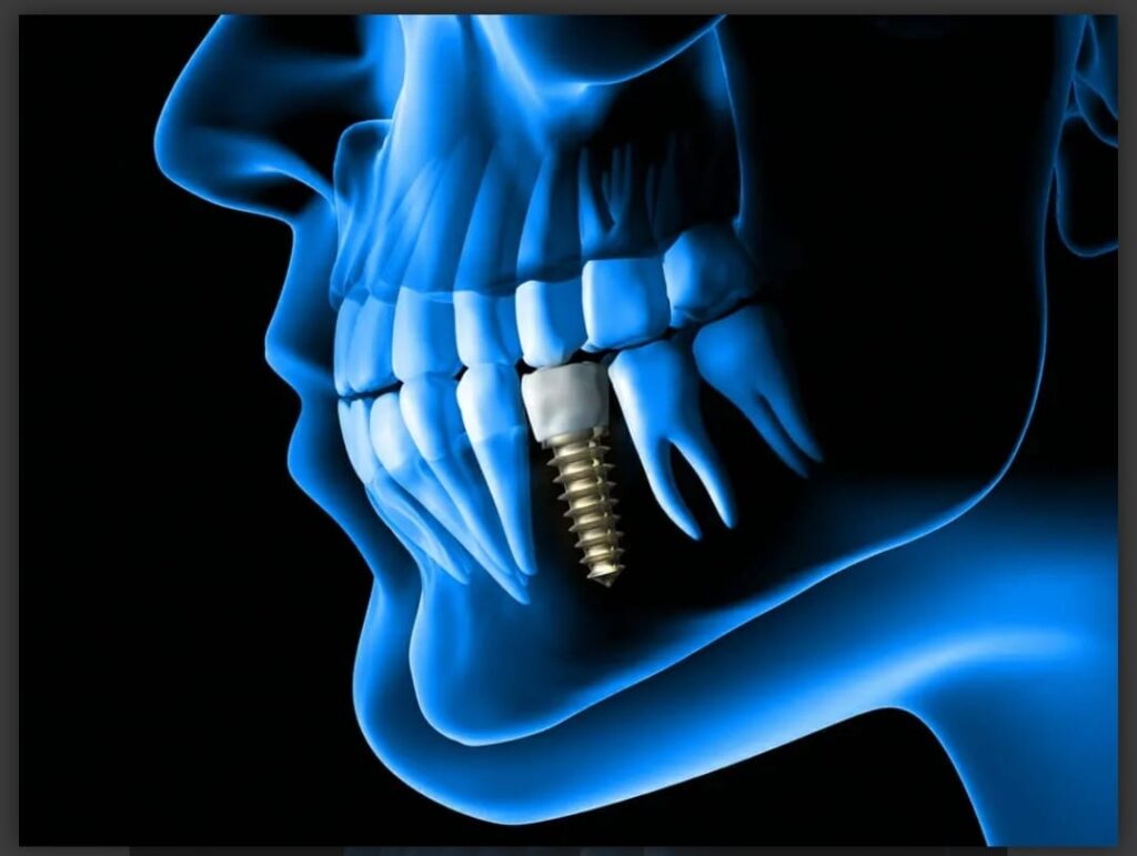 dental implant dental implant