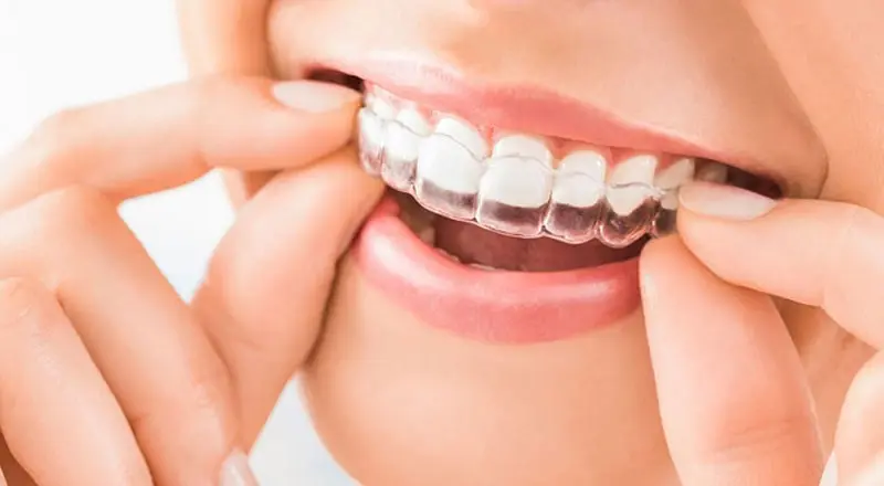 aligners orthodontic treatment aligners orthodontic treatment