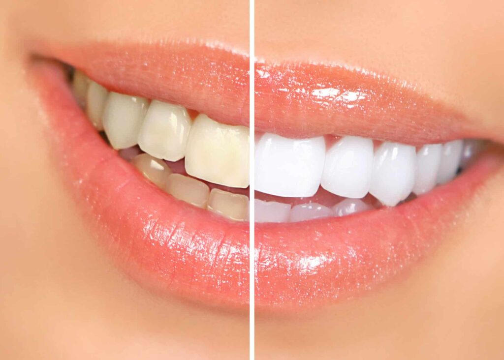 teeth whitening 1 teeth whitening 1
